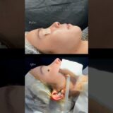 劇的変化　#形成外科専門医 #美容整形 #鼻整形 #美容 #整形 #鼻整形 #湘南美容クリニック