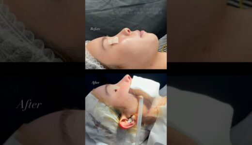 劇的変化　#形成外科専門医 #美容整形 #鼻整形 #美容 #整形 #鼻整形 #湘南美容クリニック