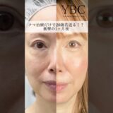 ２０歳若返る！？ダウンタイム0のクマ治療#美容 #美容整形 #イソセン#ybc横浜美容外科 #目の下のたるみ取り #目の下のクマ #若返り