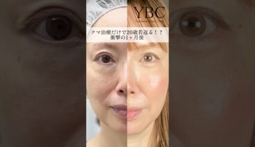 ２０歳若返る！？ダウンタイム0のクマ治療#美容 #美容整形 #イソセン#ybc横浜美容外科 #目の下のたるみ取り #目の下のクマ #若返り